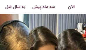 خرید عمده 20عددی تونیک رشد مو اصل تضمینی ۳۰۰ میل ارسال مستقیم از شرکت ایرانیان زمین