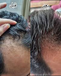 خرید عمده 20عددی تونیک کاهش ریزش مو و رشد مجدد مو کاملا اصل تضمینی ۳۰۰ میل ارسال مستقیم از شرکت ایرانیان زمین