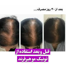 خرید عمده 20عددی تونیک کاهش ریزش مو و رشد مجدد مو کاملا اصل تضمینی ۳۰۰ میل ارسال مستقیم از شرکت ایرانیان زمین