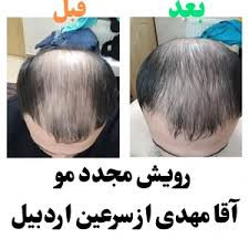 خرید عمده 20عددی تونیک کاهش ریزش مو و رشد مجدد مو کاملا اصل تضمینی ۳۰۰ میل ارسال مستقیم از شرکت ایرانیان زمین