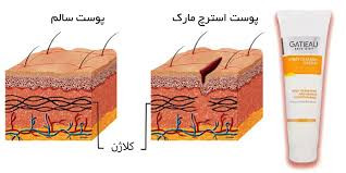 کرم رفع ترک های پوستی تضمینی ناشی از چاقی و لاغری گاتیو ایتالیا 100 میل